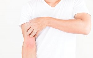 Dermatitis