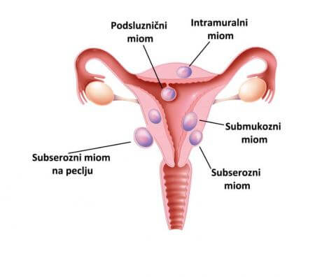 Miomi na maternici